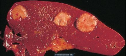 Лоша прогноза ли са разсейките на рак в черния дроб?