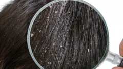 Най-ефективните масла против сух пърхот са събрани тук!