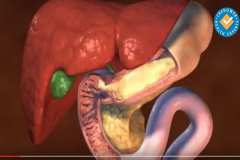 Метеоризъм - кое го причинява и как да го избегнем?