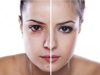 Стрес и лошо хранене увеличават риска от акне в зряла възраст