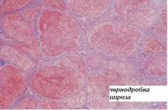 Цирозата е неканен гост