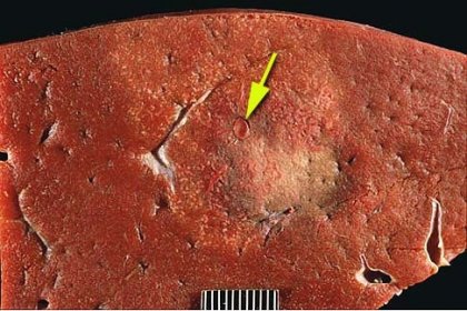 ВНИМАНИЕ! Хепатореналния синдром е сериозно заболяване!