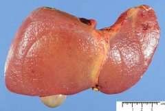 Цирозата е различна за всеки