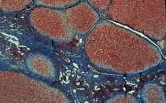 Цироза на черния дроб - как може да се разболеем?