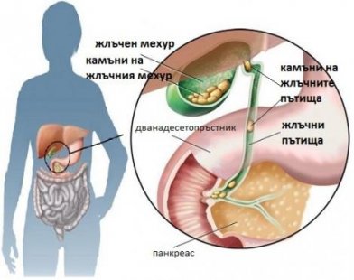 Жлъчнокаменната болест предпочита жените