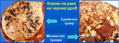Учените са разбрали как да се справят с рак на черния дроб