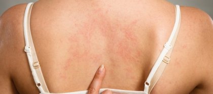 Летният загар - причина за радост, но и повод за притеснение