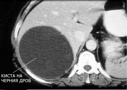 Чернодробната киста може да се появи и от травма