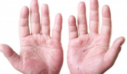 Лекарите са намерили решение за хора с тежка екзема