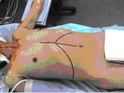 Не подценявайте чернодробната исхемия