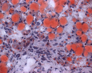 Чернодробна стеатоза – какви са вредите, които нанася това заболяване?