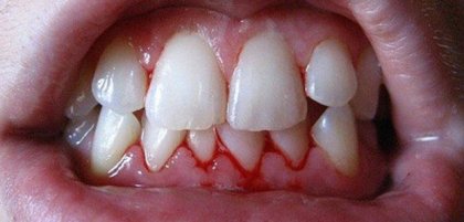 Венците могат да кървят и заради силен стрес