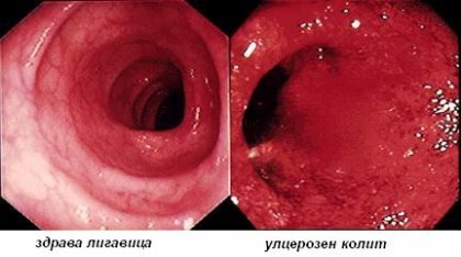 Улцерозен колит и диабет – една не много добра комбинация