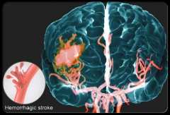 Грипът може да увеличи риска от инсулт с 40%, предупреждават невролозите