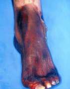 Гангрена и диабет – може ли операцията да бъде избегната?