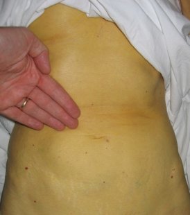 От какво възниква чернодробна недостатъчност?