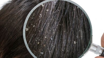 Най-ефективните масла против сух пърхот са събрани тук!