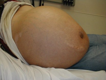 Чернодробната кома е прелюдия към рака на черния дроб