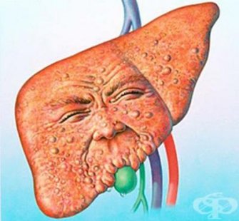 Капките Хепавитал помогнаха на моя син при стеатоза