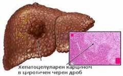 Рак на черния дроб - най-обща информация