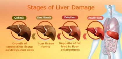 Лечението на черния дроб с капките Хепавитал даде много добри резултати