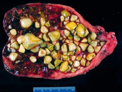 Камъните в жлъчния мехур увеличават риска от сърдечни заболявания