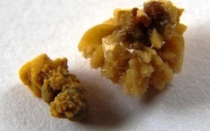 Жлъчките могат да изненадат и повече от 300 камъка!