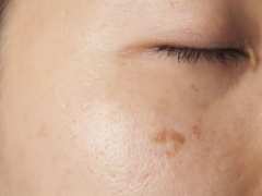 Петна по кожата - разновидности и опасности, които крият