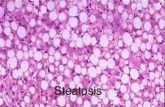 Отслабването – първа стъпка в борбата с мастния черен дроб