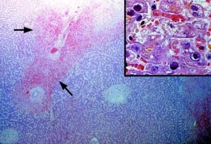 Хепатоспленомегалия – какво е това?