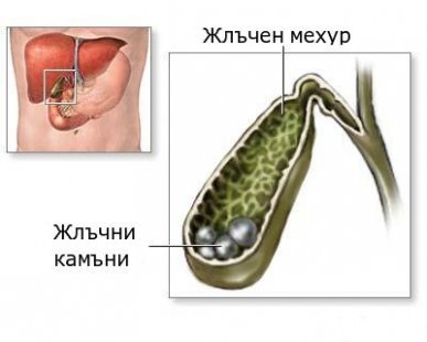 Перфорация на жлъчния мехур