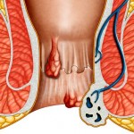 хемороиди алкохолизъм