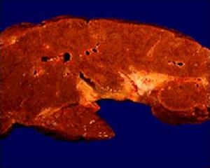 Опасна ли е цирозата за алкохолиците?