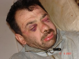 Как злоупотребата с алкохол влияе върху здравето на очите?