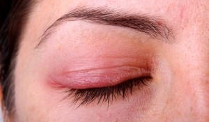 Блефарит при хора с диабет