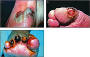 Ако не могат да бъдат избегнати трофичните язви при диабет – как да се третират?