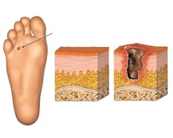 Захарен диабет – проблемите с краката, които може да си спестите