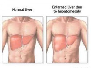 20111217161253hepatomegaly