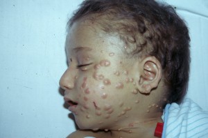 Xanthoma due to hypercholesterolemia