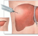 чернодробна биопсия