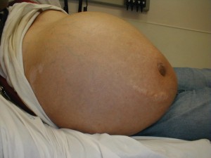 чернодробна кома