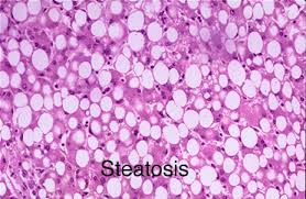 стеатоза