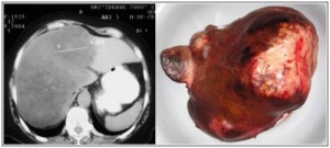 tumor na `erniq drob