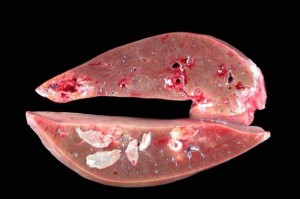 Лечението на чернодробен абцес включва антибиотици и често хирургичен дренаж 