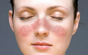 Заболяванията на черния дроб се отразяват върху кожата и лицето