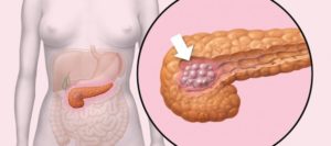  рак на панкреаса