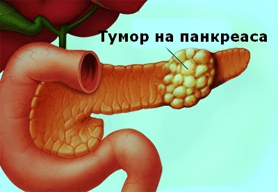 Карцином на панкреаса - причини и лечение