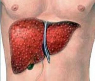 Хепатоцелуларен аденом