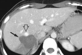 Хемангиом на черния дроб и каква е прогнозата?