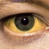 На какво може да се дължи пожълтяването на очите при деца и възрастни?